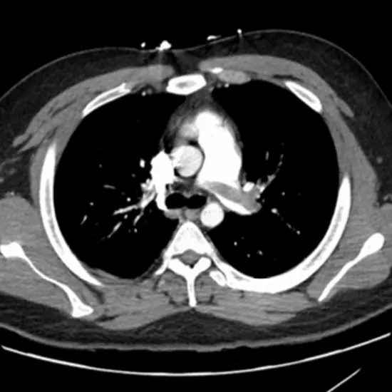 CT Angiography Thoracic